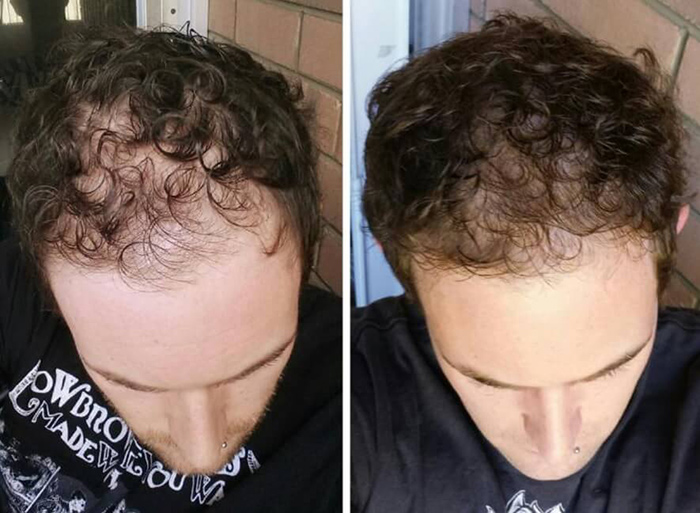 Minoxidil Opiniones ⇒ 【↓¿Merece Realmente la Pena↓】