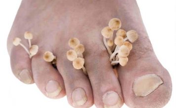 Remedios caseros para los hongos en los pies y uñas remedios caseros para los hongos de los pies
