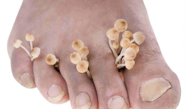 remedios caseros para los hongos de los pies