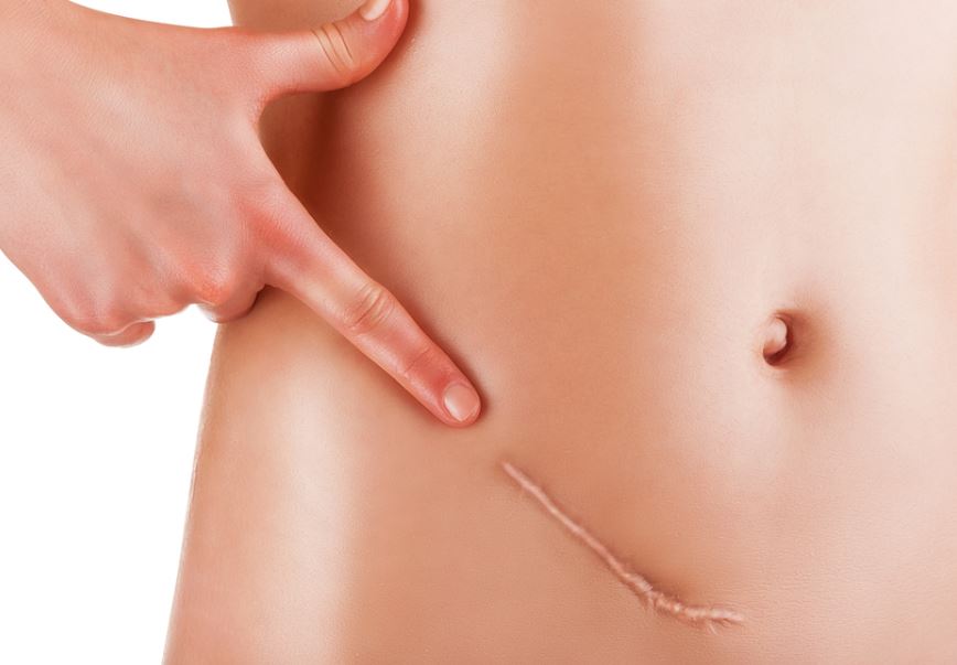 apendicitis inflamada
