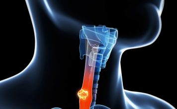 cancer de esofago fotos imagenes