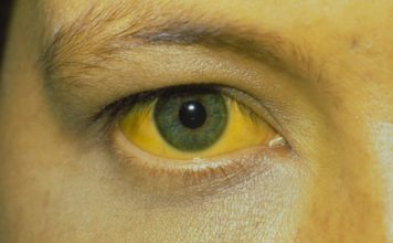 Bilirrubina alta en sangre; Causas, síntomas y tratamiento bilirrubina color amarillo