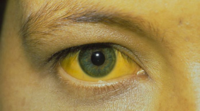 bilirrubina color amarillo