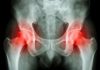 bursitis trocantérea