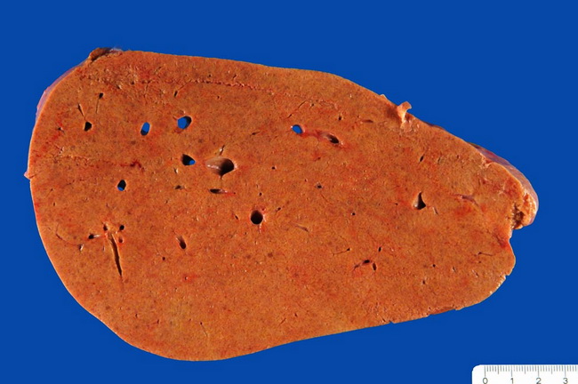 esteatosis hepatica alcoholica fisiopatologia