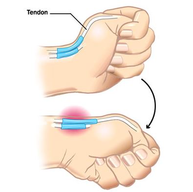 Cómo saber si tengo una tendinitis o una tendinopatía