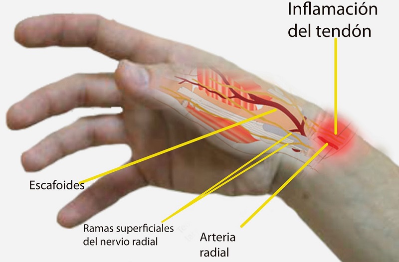 q es la tendinitis en imagenes
