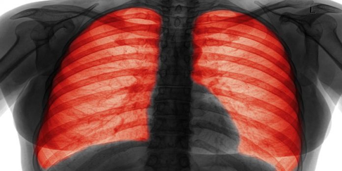 tratamientos enfisema pulmonar causas