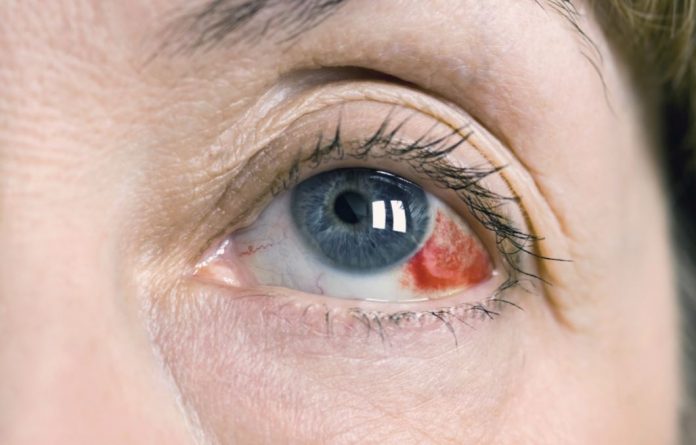 derrame en el ojo por golpe tratamiento