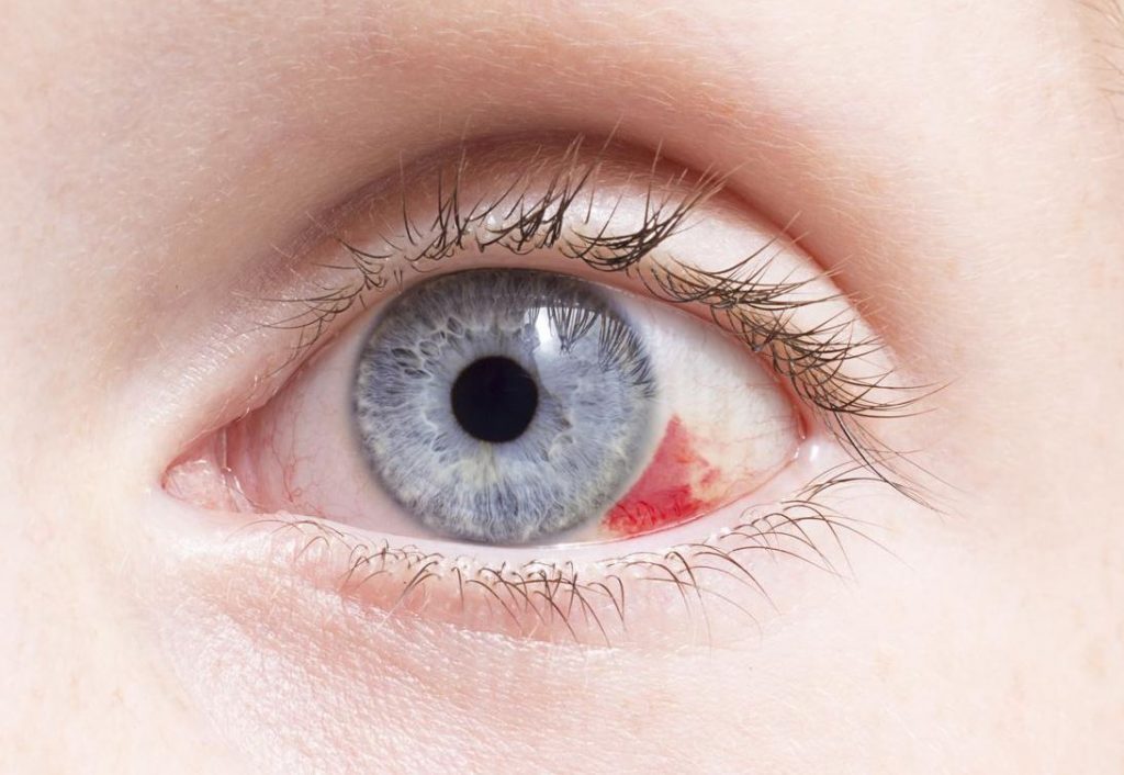 dolor ojo izquierdo