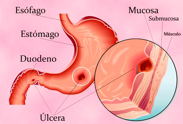 gastritis nerviosa