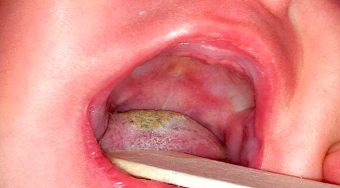 hongos en la lengua sintomas