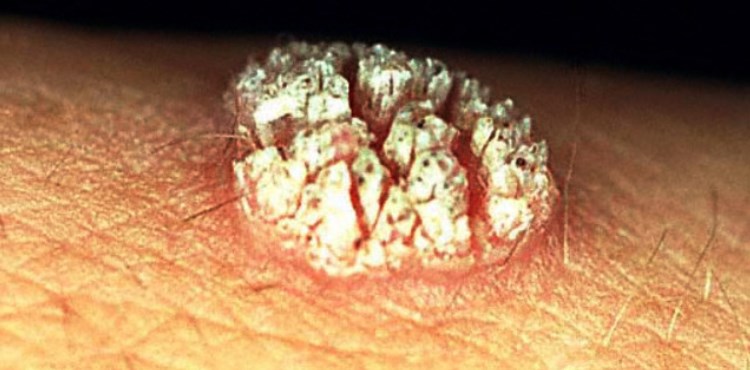 verruga genital fotos imagenes