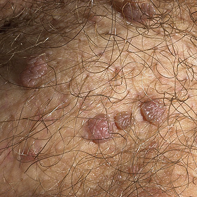 verrugas genitales pene fotos