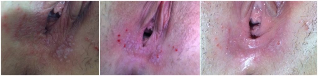 verrugas vaginales fotos imagenes
