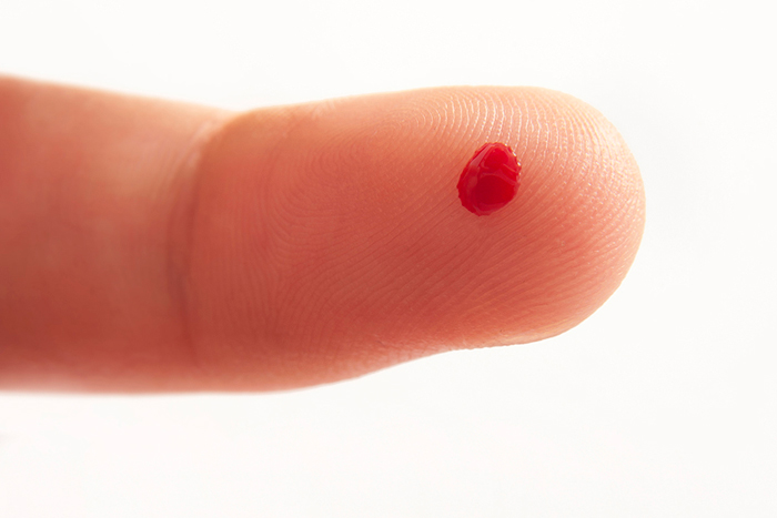 anemia hipotiroidismo