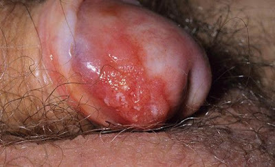 cancer de pene sintomas fotos cancer de pene sintomas fotos