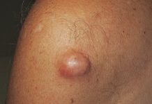 Quiste Pilonidal Sacro S ntomas Y Tratamiento 