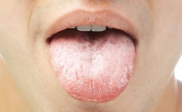 sintomas de cancer de lengua imagenes