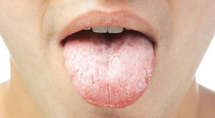 Cáncer de lengua; ¡Mucho cuidado con los primeros síntomas! sintomas de cancer de lengua imagenes