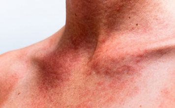 queratosis actinica fotos imagenes