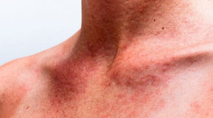 Queratosis actínica; Causas, síntomas, tratamiento y mucho más queratosis actinica fotos imagenes