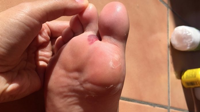 como quitar las ampollas de los pies con exito