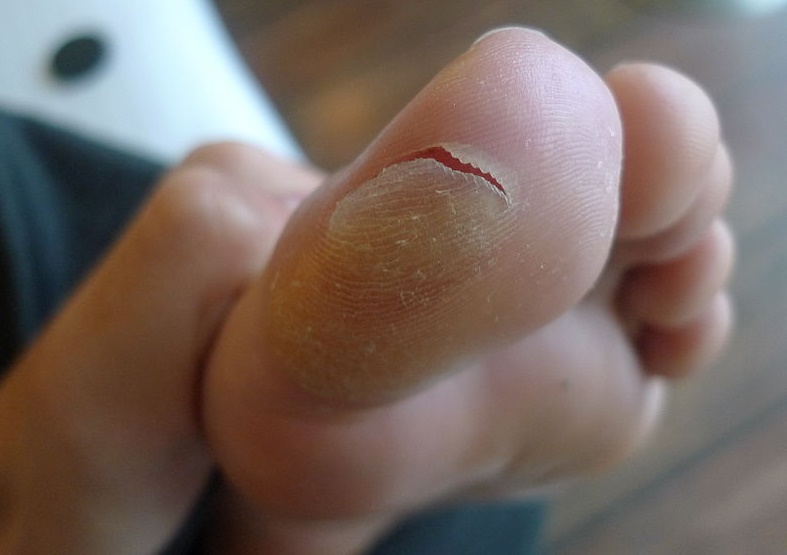 que son las ampollas que salen en los pies