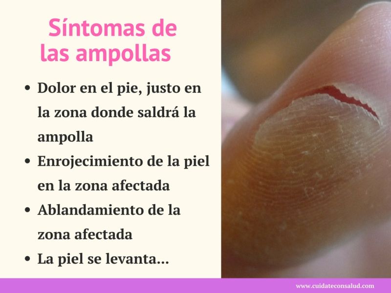 sintomas de ampollas en la piel