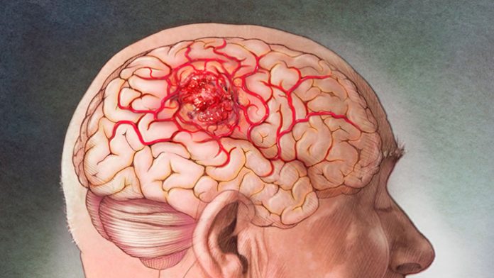 Edema Cerebral ⇒ 【↓Causas, Síntomas y Tratamiento↓】