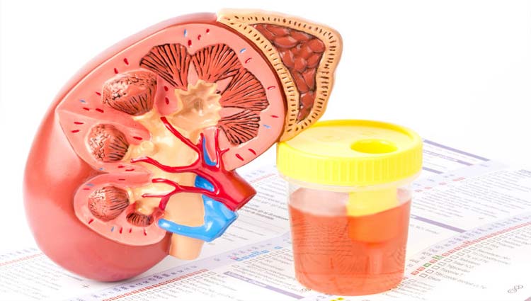 hematuria macroscópica en ancianos
