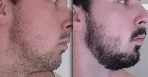 minoxidil barba antes y despues resultados minoxidil barba antes y despues resultados