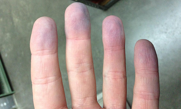 soplo en el corazon en adultos consecuencias