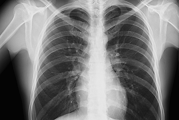 soplo pansistolico radiografia