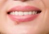 como curar calenturas en los labios