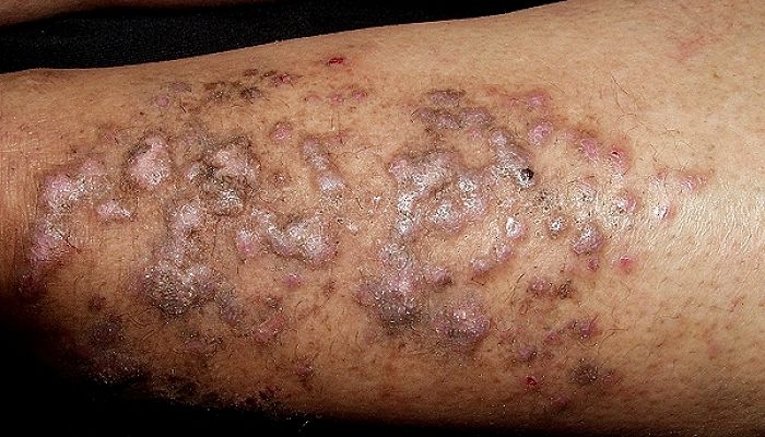 enfermedad liquen enfermedad liquen