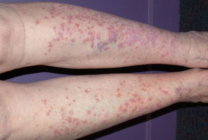 que es el lichen planus que es el lichen planus