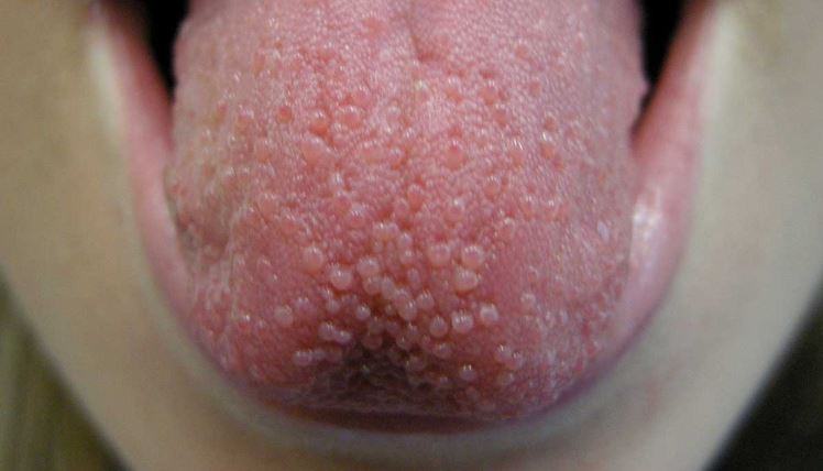 papilas gustativas irritadas y dolor de garganta