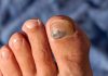 Como tratar las uñas negras de los pies uñas negras delos pies que significa