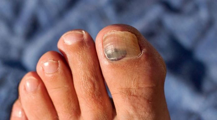 uñas negras delos pies que significa