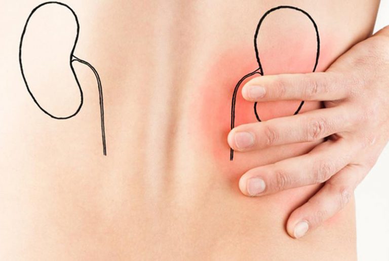 Dolor de Riñones 【¡Causas, Síntomas y Tratamiento!】