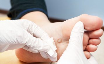 verrugas plantares en niños tratamiento