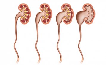 Dolor de Riñones 【¡Causas, Síntomas y Tratamiento!】