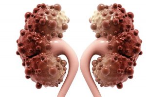 Dolor de Riñones 【¡Causas, Síntomas y Tratamiento!】