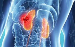 Dolor de Riñones 【¡Causas, Síntomas y Tratamiento!】