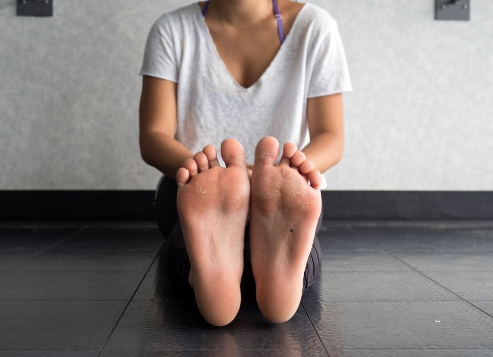 tipos de callos en los pies fotos tipos de callos en los pies fotos