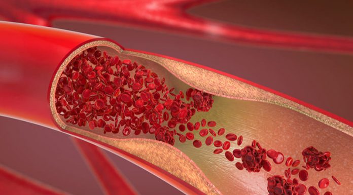 arterias obstruidas en las piernas