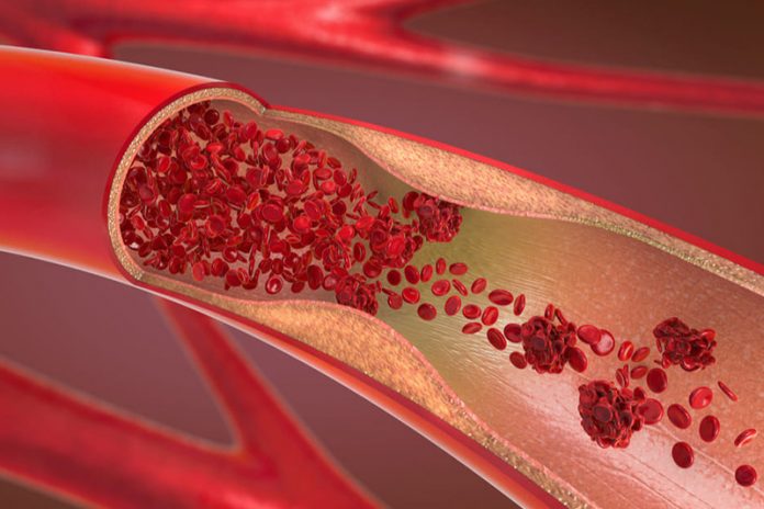arterias obstruidas en las piernas