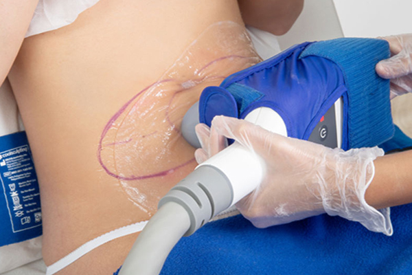 antes y después coolsculpting