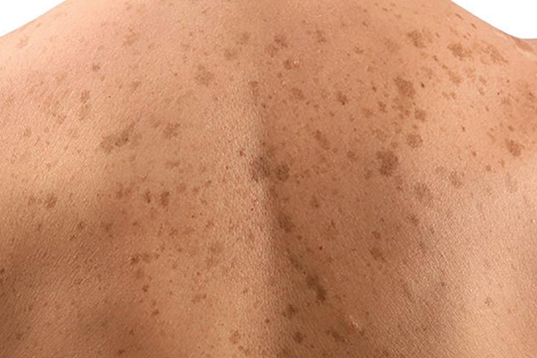 despigmentación piel despigmentación piel